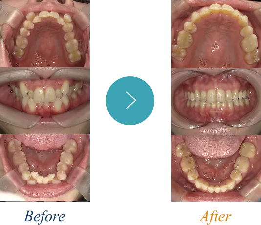 叢生(歯の重なり)の症例